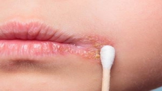 Nhiễm Virus Herpes Simplex